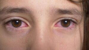 A Boy's pink Eyes suffering from conjunctivitis