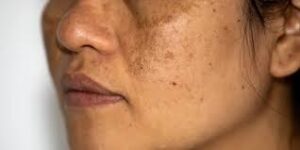 showing half face of women with pigmentation